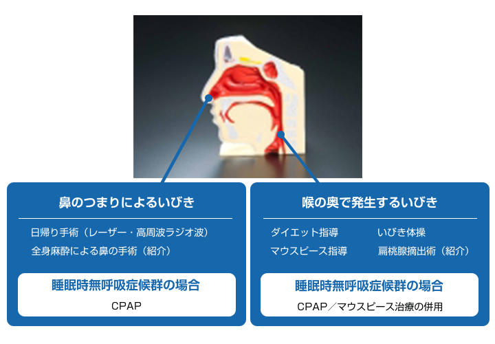 鼻で起きるいびきと、のどで起きるいびき